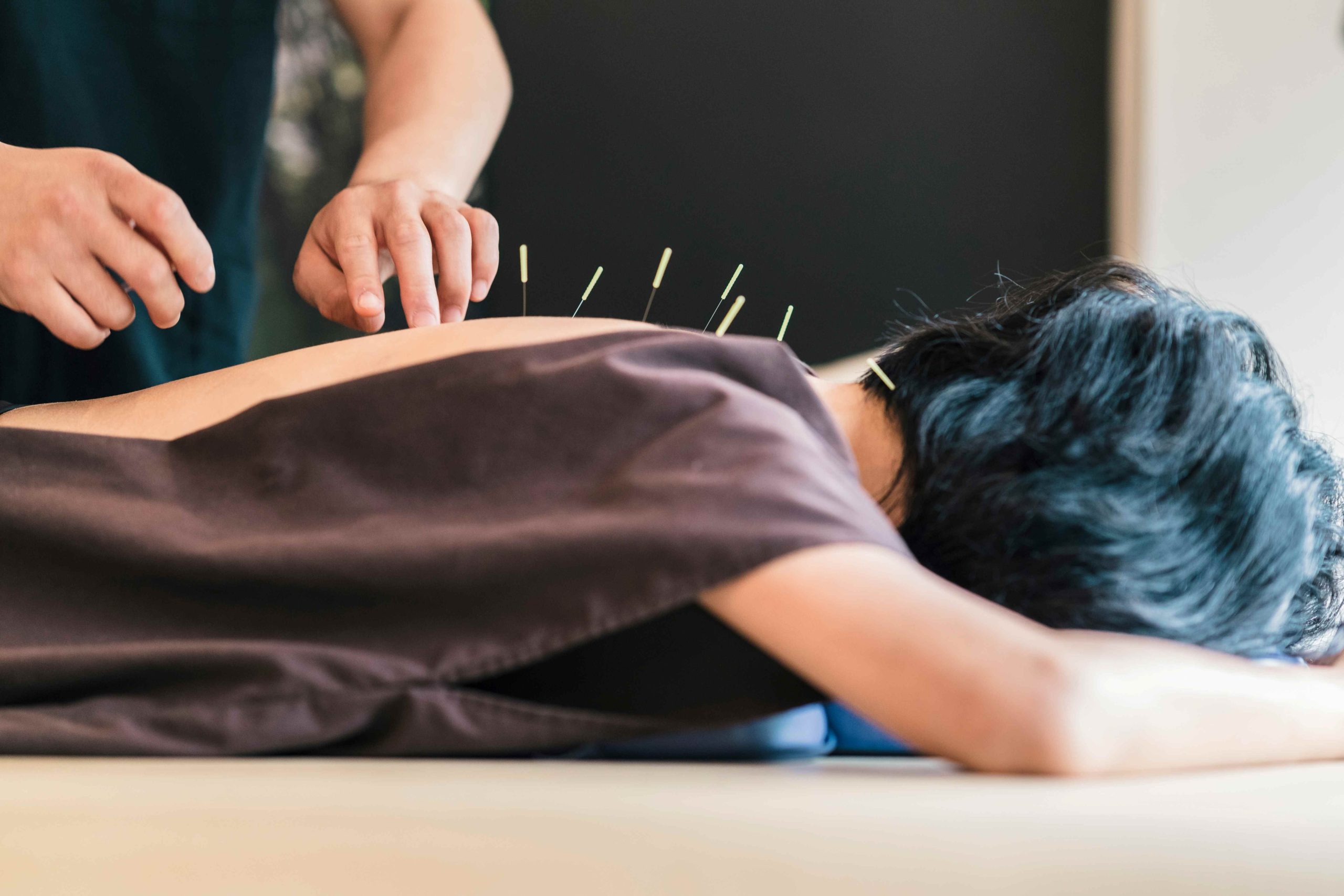 woman getting acupuncture treatment